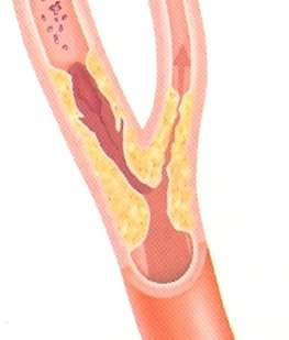 Illustration of Carotid Stenosis