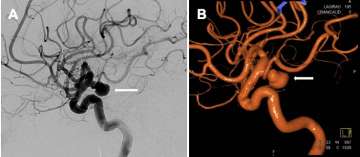 Cerebral Angiogram