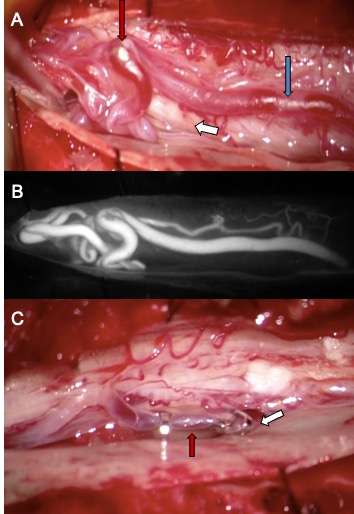 Image of Spinal Fistula Treatment 