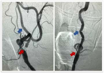 cerebral angiogram image