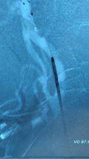Medical imaging of a catheter inserted into a blood vessel.