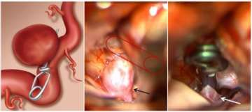 An illustration (left) of a clip placed across the neck of the brain aneurysm