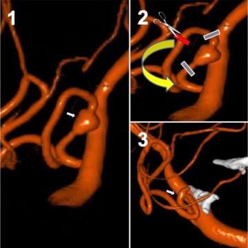 Illustration of dissecting Posterior Inferior Cerebellar Artery