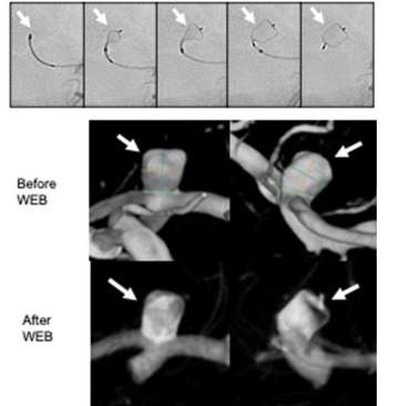 Sequential images of aneurysm