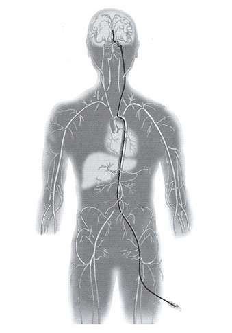 Figure 6. The catheter is carefully threaded up into the brain.