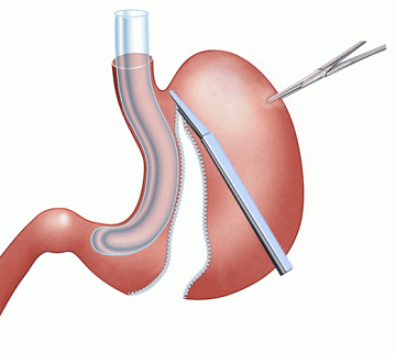 Gastric Sleeve Illustration