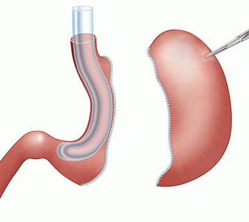 Gastric Sleeve Illustration