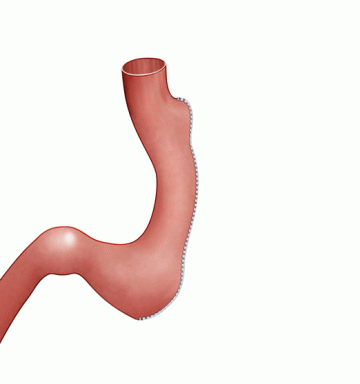 Gastric Sleeve Illustration