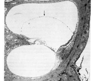 Endolymphatic hydrops are seen in middle turn of chinchilla cochlea four weeks following endotoxin instillation into the bulla