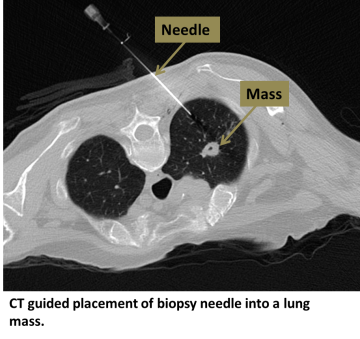 CT guided placement of biopsy needle into a lung mass