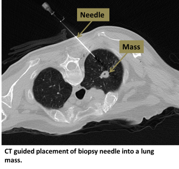 CT guided placement of biopsy needle into a lung mass