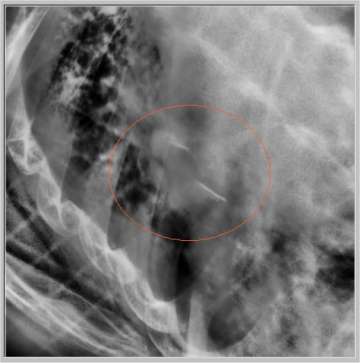 lung
