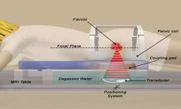 MR Guided Focused Ultrasound procedure