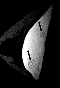 Figure 4: Sagittal silicone-excited MR with arrows showing hypointense curvilinear lines (linguine sign) (arrows).