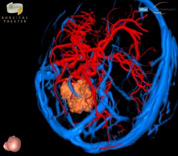 Medical scan shows a brain's blood vessels in blue and red, with a beige tumor highlighted in the center. Click image to enlarge
