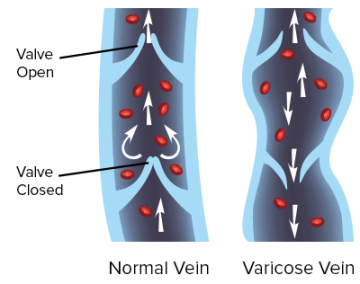 Vericose Veins