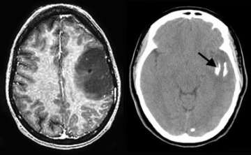 Oligodendroglioma