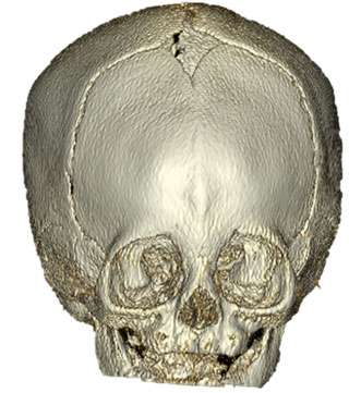 Metopic Craniosynostosis