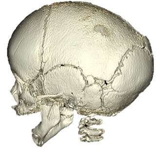 Sagittal Synostosis