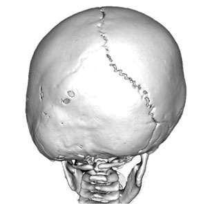 Sagittal Synostosis