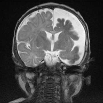 Sturge Weber Syndrome