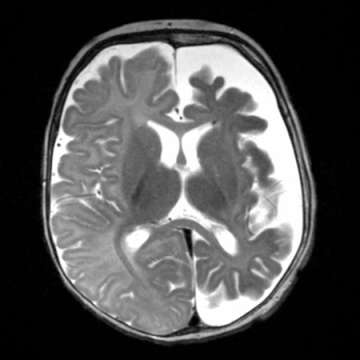 Sturge Weber Syndrome