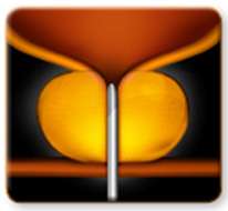 UroLift Device