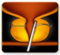 UroLift Device Procedure Step 3
