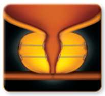 UroLift Device Removal