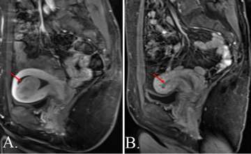 Uterine Fibroid