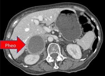 Von Hippel-Lindau Syndrome