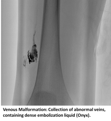Venous Malformation: Collection of abnormal veins, containing dense embolization liquid (Onyx)