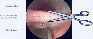 Endoscopic View of Zenker's Pouch During Surgery.