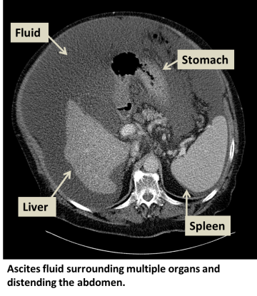 Ascites X-Ray Image