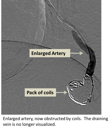 Enlarged artery obstructed by coils. The draining vein is no longer visualized.