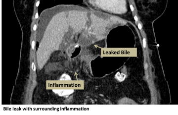 Biliary Leak Image