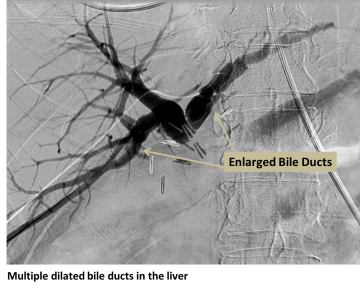 Biliary Obstruction in the liver