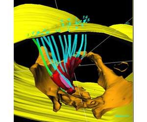 brachytherapy catheters