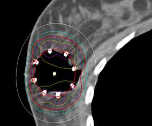 lumpectomy cavity