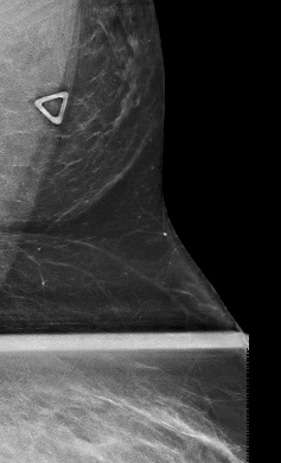 Case: Accessory Breast Tissue Figure 1