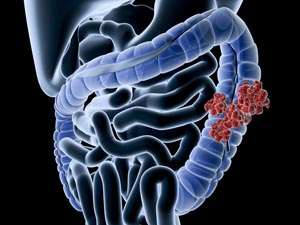 Colon cancer stock image