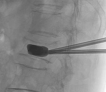 Figure 5. Balloons are inflated within the fractured vertebral body in order to regain the height and also to create a cavity into which thick cement can be injected (Kyphoplasty).