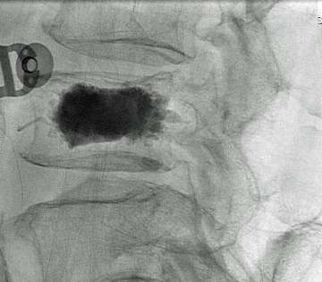 Figure 6. The cement hardens in 10-15 minutes and completely stabilizes the vertebral body from the inside.