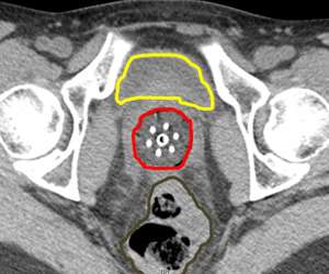 CT Scan