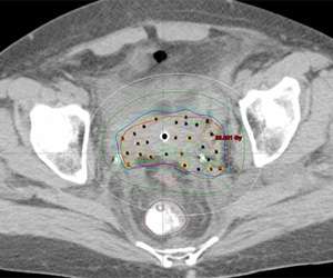 axial CT slice