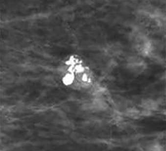 Coarse or popcorn-like calcifications