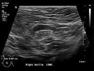 Case: Axillary Lymphadenopathy Figure 3
