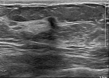 Case: Inflammatory Breast Cancer Figure 5