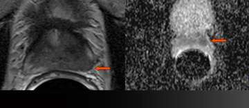 Extracapsular Extension and Seminal Vesicle Invasion by MRI