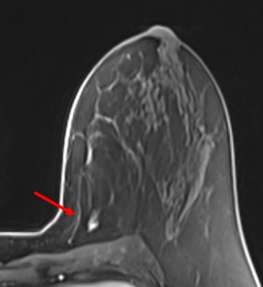 Case: LCIS Figure 2